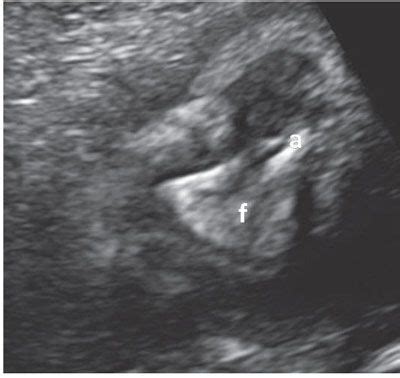 Normal Fetal Ultrasound Survey | Radiology Key