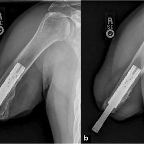 Right transhumeral amputation following targeted muscle reinnervation... | Download Scientific ...