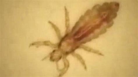 ‘Super lice’ spreads across half the country | Sacramento Bee