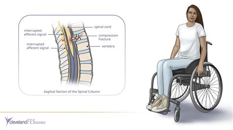 Spinal Cord Injury – The Cleveland FES Center