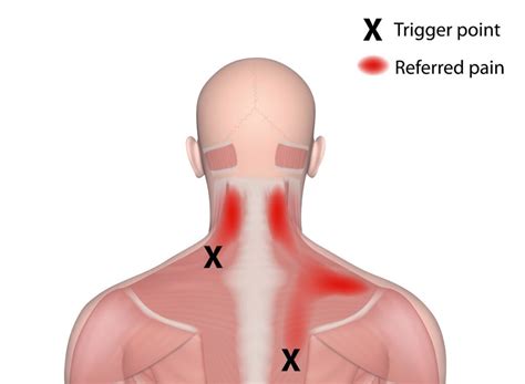 Myofascial Pain Syndrome | Roziermd