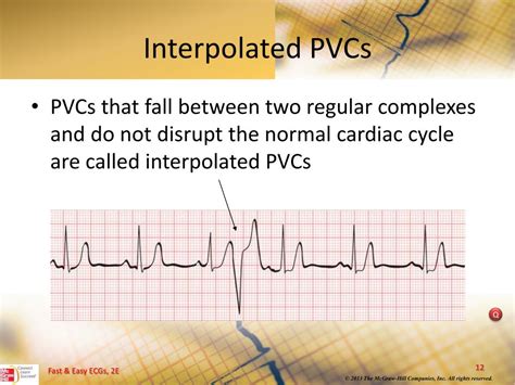 PPT - Ventricular Dysrhythmias PowerPoint Presentation, free download - ID:5204970