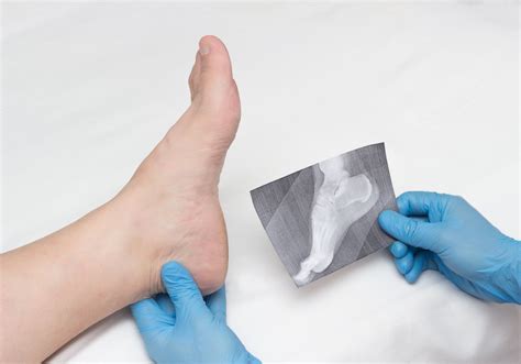 Bone spurs: Causes, symptoms, and treatment in Scottsdale – Arizona Foot Doctors