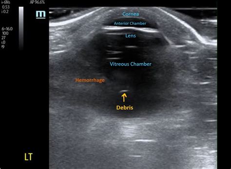 Gaining the Diagnosis of Vitreous Hemorrhage with Ultrasound – MED-TAC International Corp.