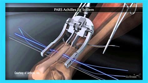 Minimally Invasive Surgery for Achilles Tendon Repair