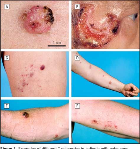 Lymphoma, Primary Cutaneous Anaplastic Large Cell | Semantic Scholar