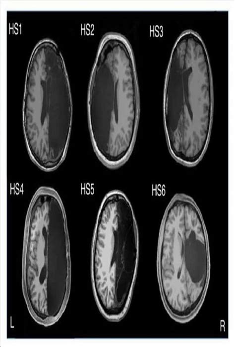 Brain scans reveal how the human brain compensates when one hemisphere ...