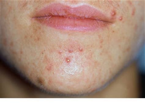 Acne and treatment options: Frequently Asked Questions - Doctor Fox