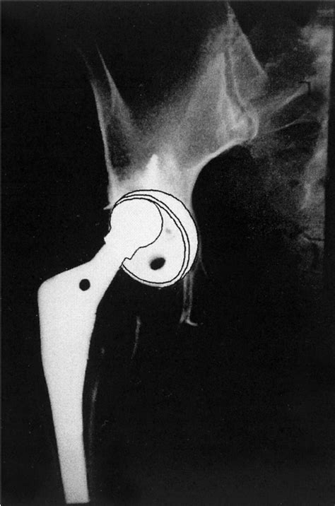 After metal-on-polyethylene total hip arthroplasty, the femoral head ...