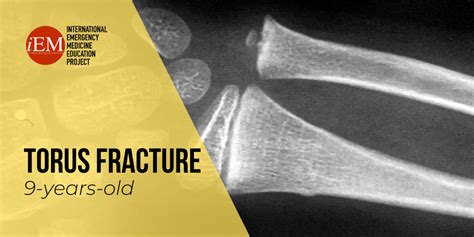 Torus Fracture - Diagnosed with ultrasound – International Emergency Medicine Education Project