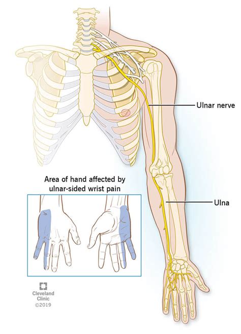 Ulnar Wrist Pain