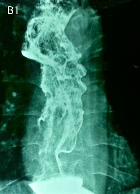 ERCP & EGD : Stage IV esophageal cancer with bronchoesophageal fistula