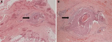 What if a surgically removed neck lymph node turns out to be cancer? – Atlas of Science