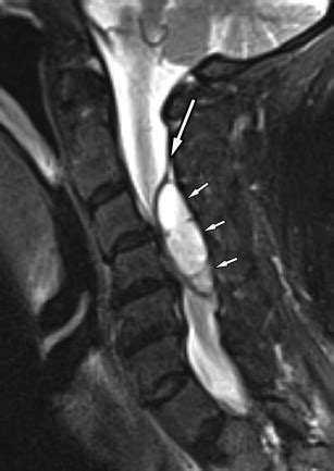 Epidural Hematoma | Radiology Key