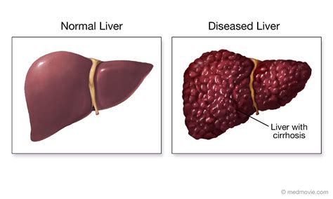 Normal Liver and Liver with Cirrhosis – Medmovie.com