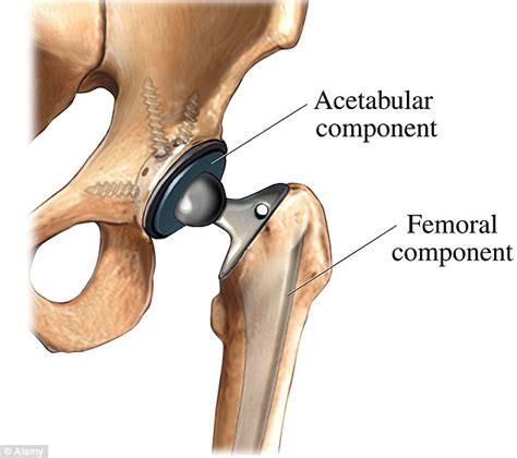 NHS to be banned from using 'toxic' metal hip replacements after ...