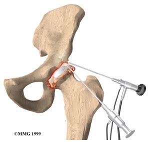 Artroscopia de Cadera - Dr Jose Ignacio Gimeno Abad