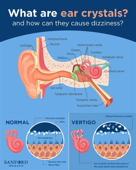 What Causes Crystals In Ear To Move at Anthony Best blog