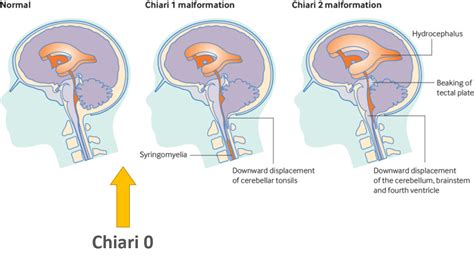 Chiari malformation treatment