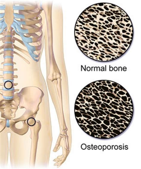 DEXA Scan Bone Density Test