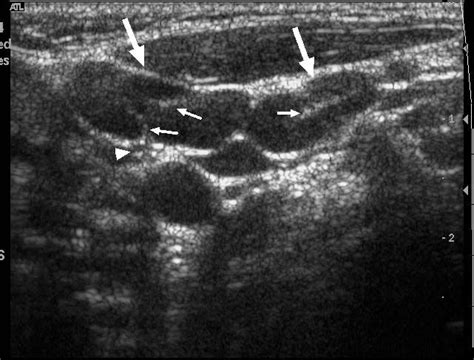 Longitudinal sonogram showing multiple reactive lymph nodes (arrows) in the posterior triangle ...