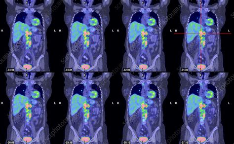 Non-Hodgkin's lymphoma, CT and PET scans - Stock Image - M134/0687 - Science Photo Library