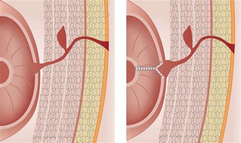 Mistakes in the management of enterocutaneous fistulae and how to avoid ...