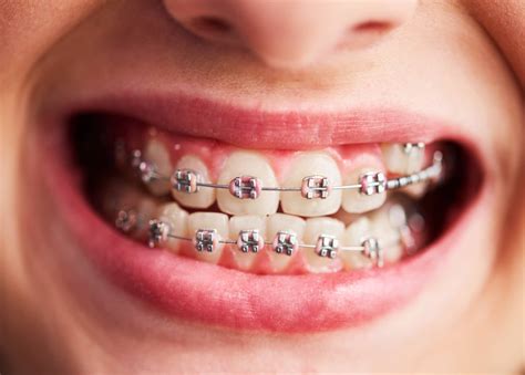 Know the dangers of fake braces --- Somos Dental