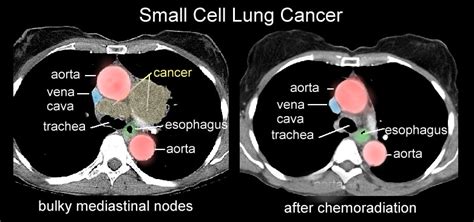 Small Cell Lung Cancer: April 2015