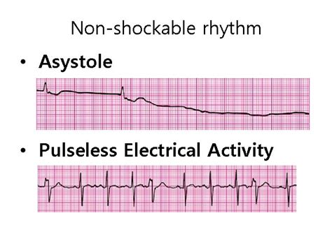 Images Of Pulseless Electrical Activity | Hot Sex Picture