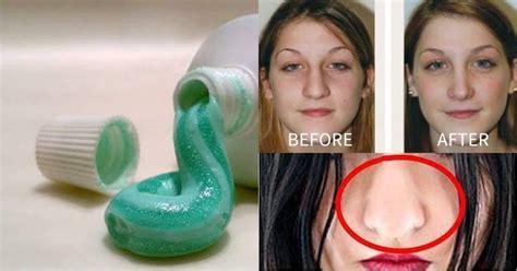 Home Remedy To Make Fat Nose Thinner Naturally Without Surgery