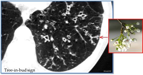 Tree-in-bud sign: Refers to the pattern of opacity seen in a HRCT; the ...