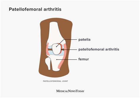 Patellofemoral arthritis: Causes, symptoms, and more