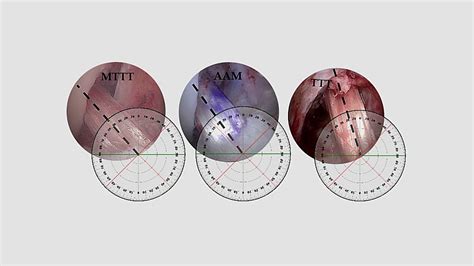 Modified transtibial VS anteromedial portal techniques – Video abstract [ID 157729] - YouTube