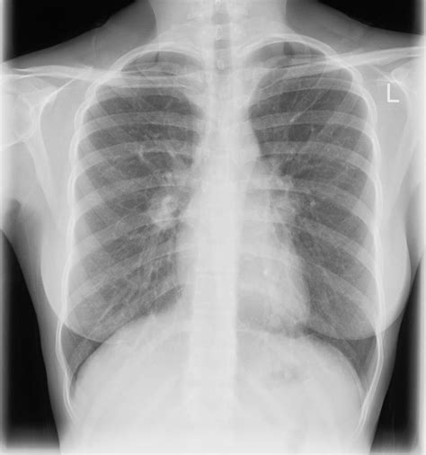 Stage 3 Lung Cancer Definition Rit Radiology: 2009 Non-Small Cell Lung Cancer Staging System (3)