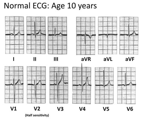 Normal paediatric ECG • LITFL • ECG Library Diagnosis