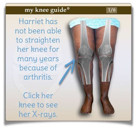 Harriet's knee with x-rays showing her arthritis. - My Knee Guide X-ray ...