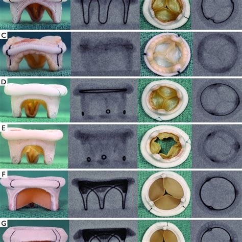 Surgical bioprosthetic mitral valves and their fluoroscopic appearance.... | Download Scientific ...