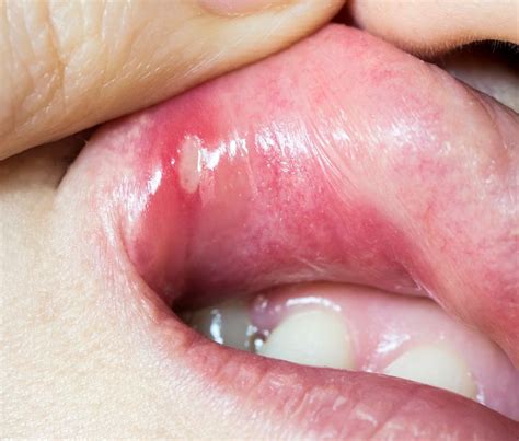 5 Ways to Treat Canker Sores at Home - Natural Remedies, Relieve Pain