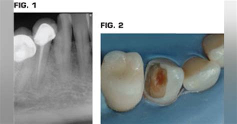 Pulp cap, endodontics, or extract? | Dental Economics