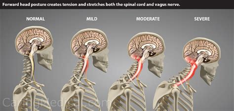 Vagus nerve compression in the neck: Symptoms and treatments