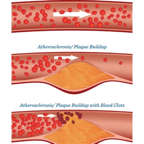 How To Detect Atherosclerosis - Faultconcern7