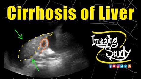 Cirrhosis of Liver || Ultrasound || Case 174 - YouTube