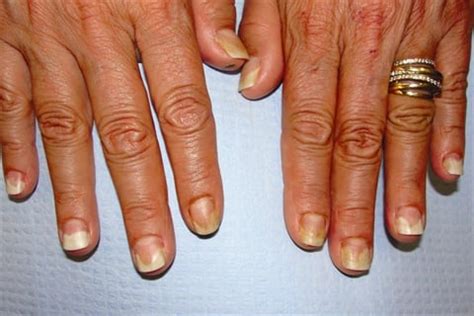 Under the Microscope: Onycholysis - Health - NAILS Magazine