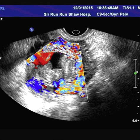 Ultrasound imaging indicated the adnexal mass. A complex adnexal mass ...