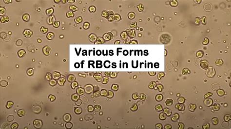 Various Forms of RBCs in Urine Microscopy I hematuria - YouTube