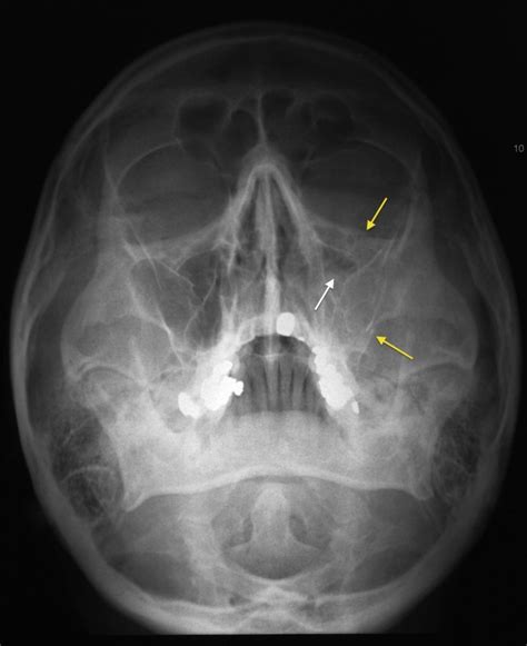 Tripod fracture - Radiology at St. Vincent's University Hospital