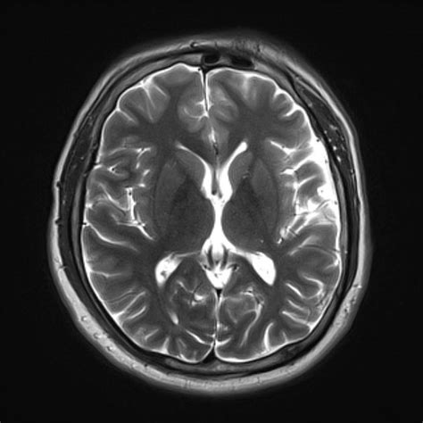 Temporal lobe atrophy | Radiology Case | Radiopaedia.org | Radiology ...