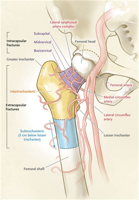 Management of Acute Hip Fracture | New England Journal of Medicine