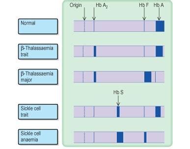 Hemoglobin electrophoresis | Medical Laboratories